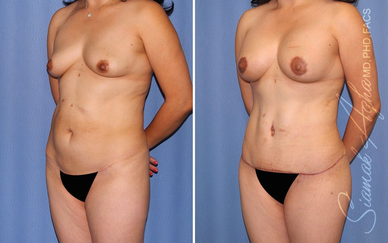 Mommy Makeover Before & After