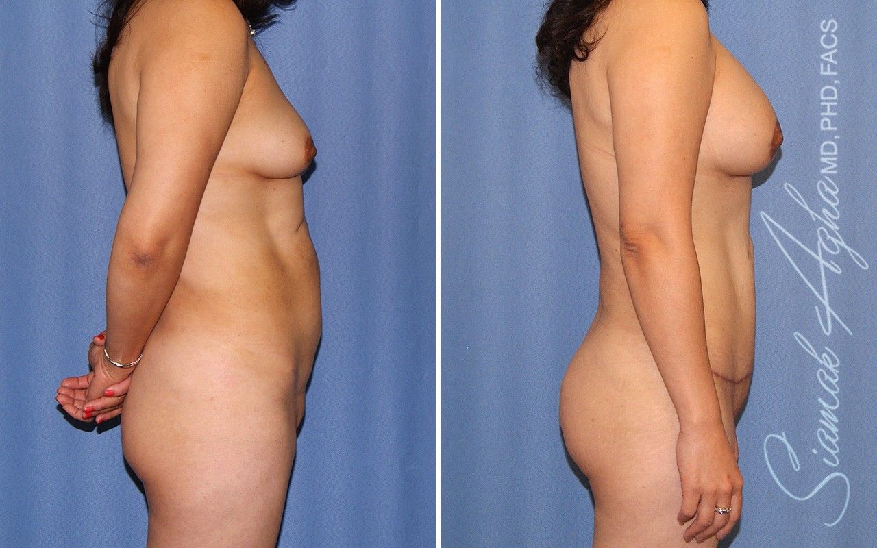 Mommy Makeover Before & After