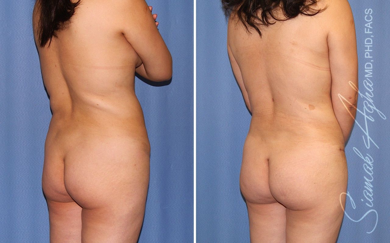 Mommy Makeover Before & After