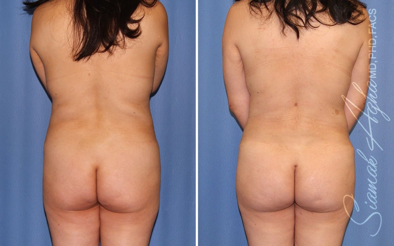 Mommy Makeover Before & After