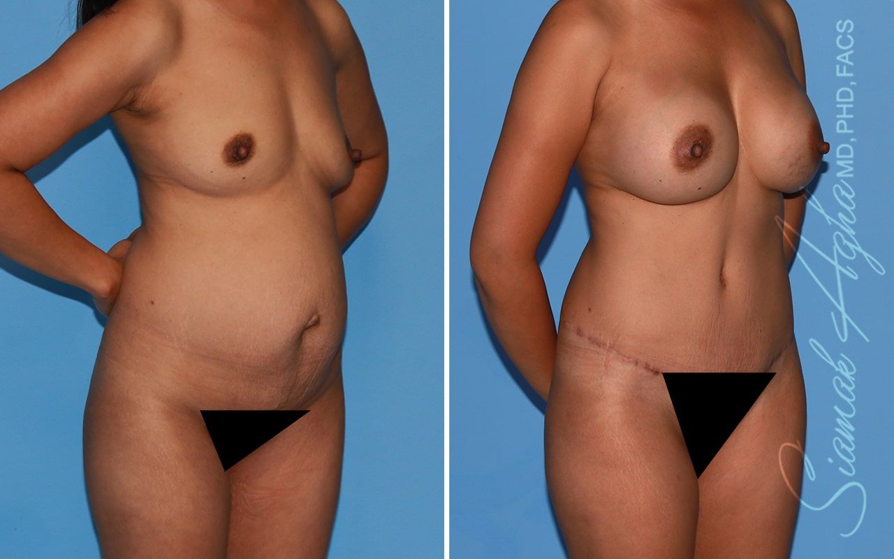 Mommy Makeover Before & After