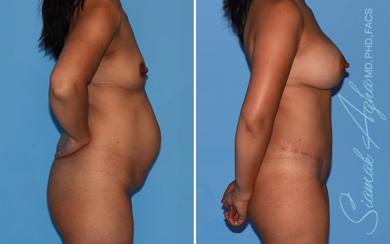 Mommy Makeover Before & After