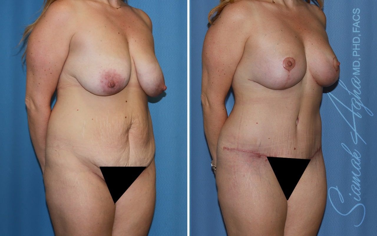 Mommy Makeover Before & After