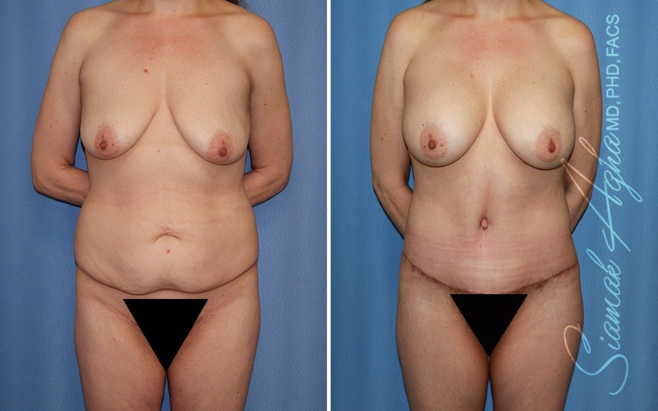 Mommy Makeover Before & After