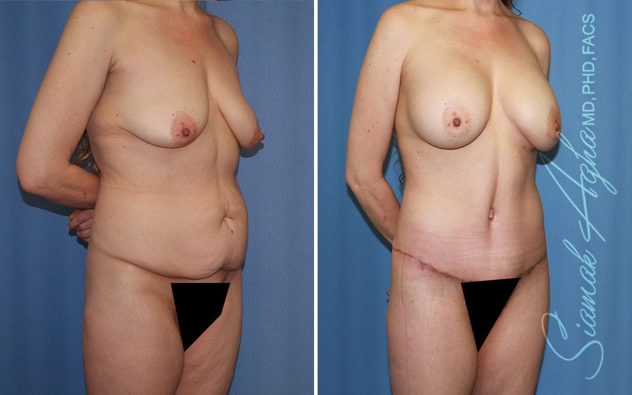 Mommy Makeover Before & After