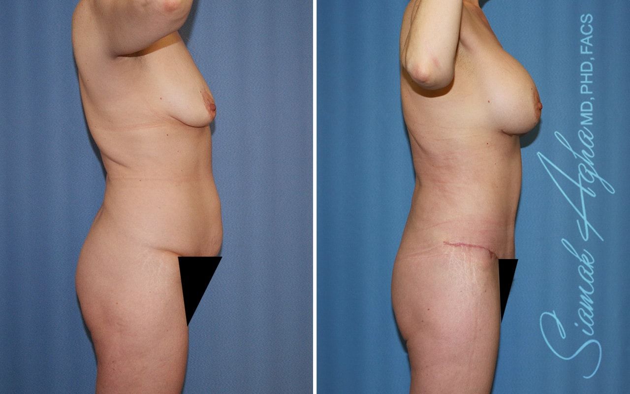 Mommy Makeover Before & After