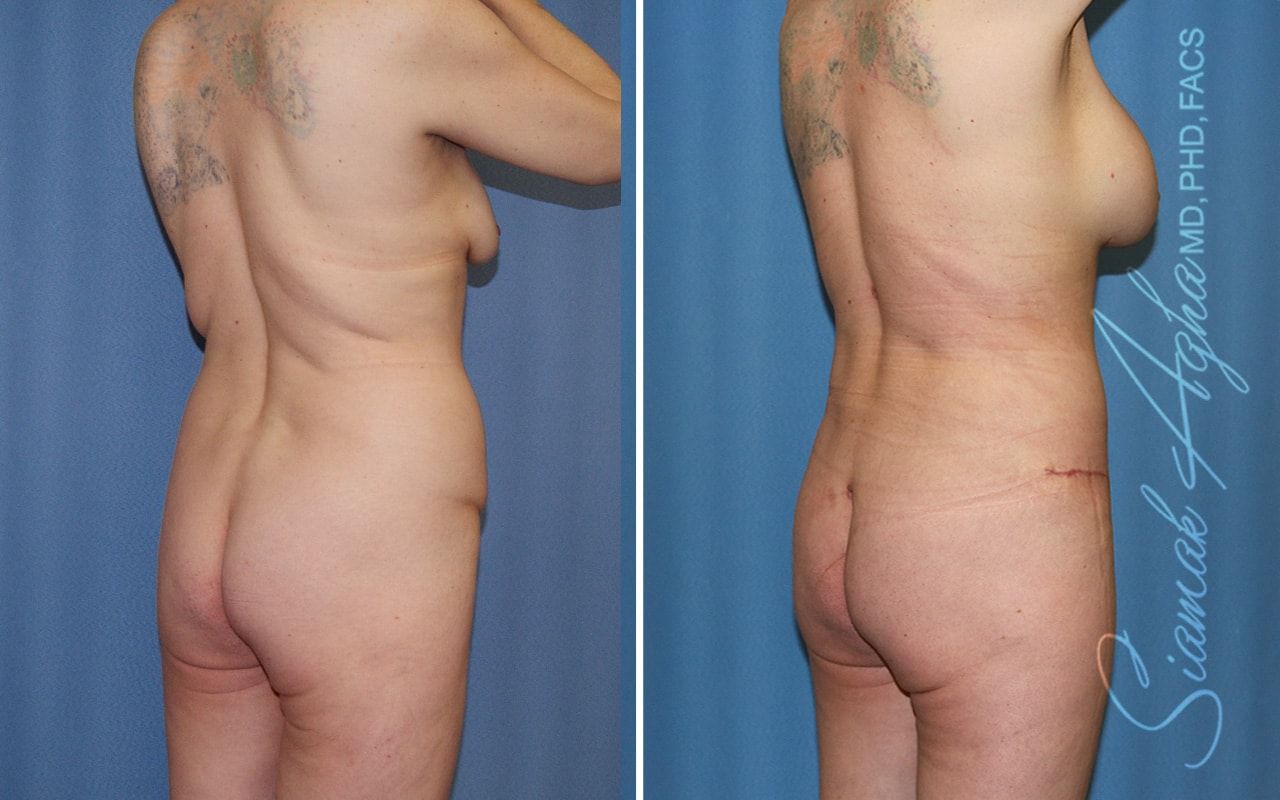 Mommy Makeover Before & After