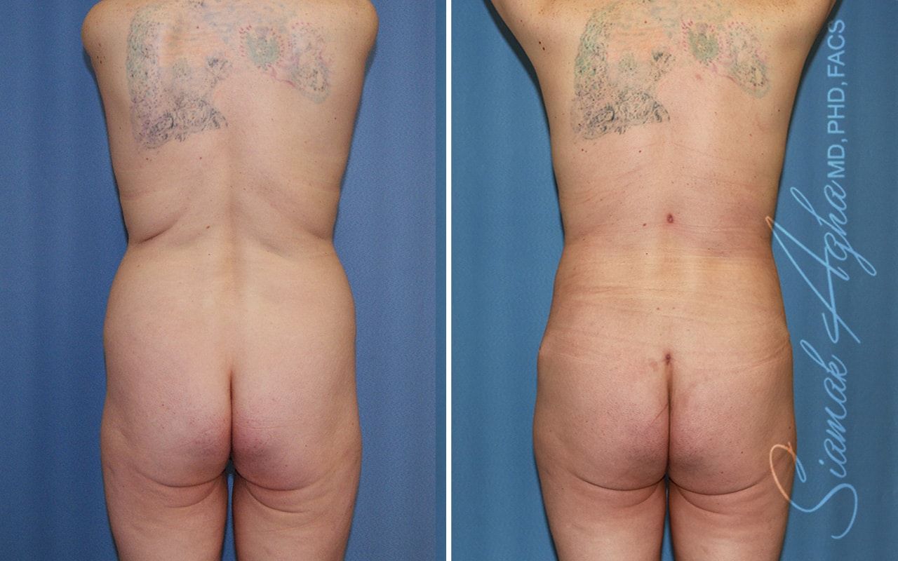 Mommy Makeover Before & After