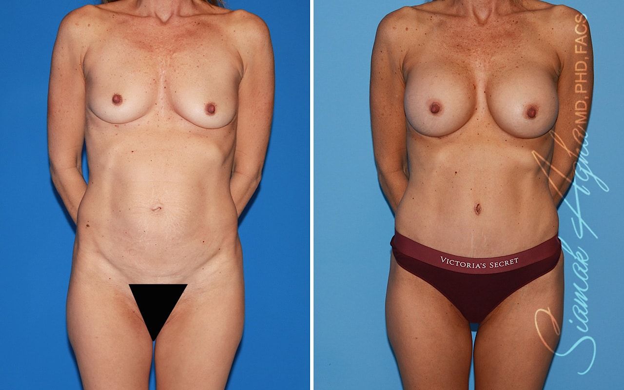 Mommy Makeover Before & After