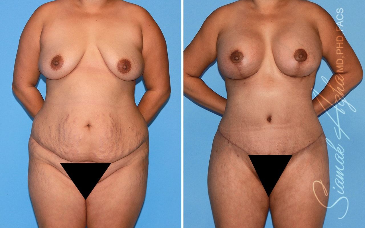 Mommy Makeover Before & After