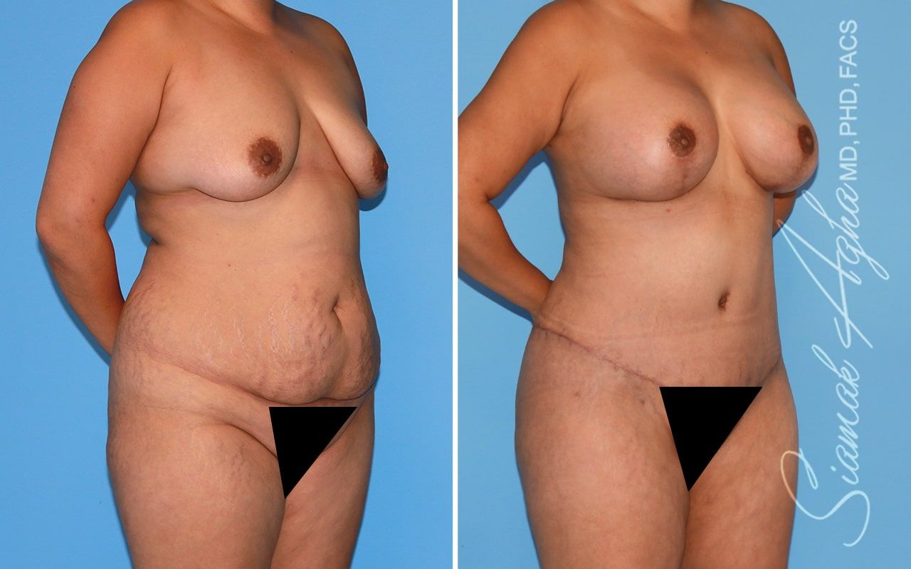 Mommy Makeover Before & After