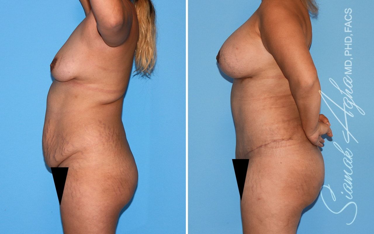 Mommy Makeover Before & After