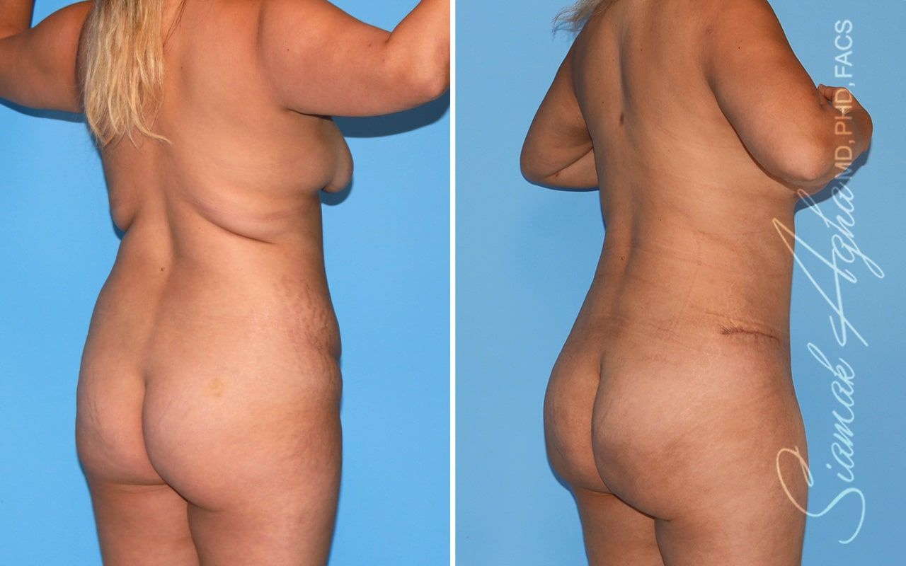 Mommy Makeover Before & After