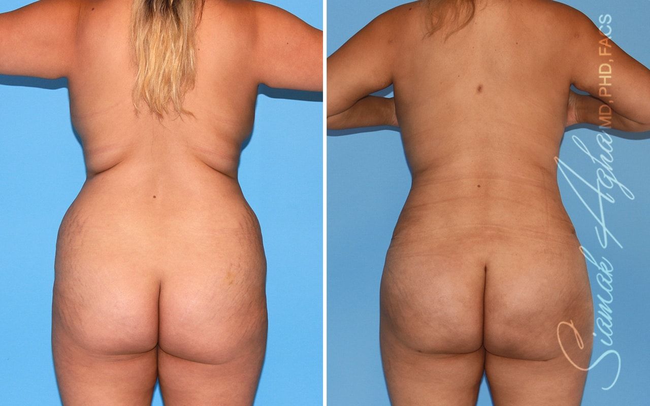 Mommy Makeover Before & After