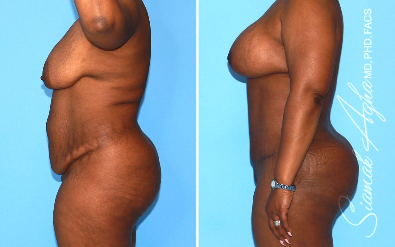 Mommy Makeover Before & After