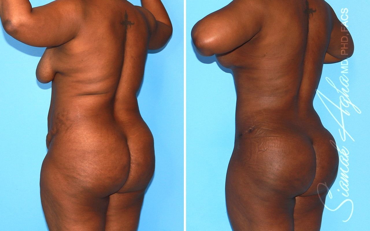 Mommy Makeover Before & After