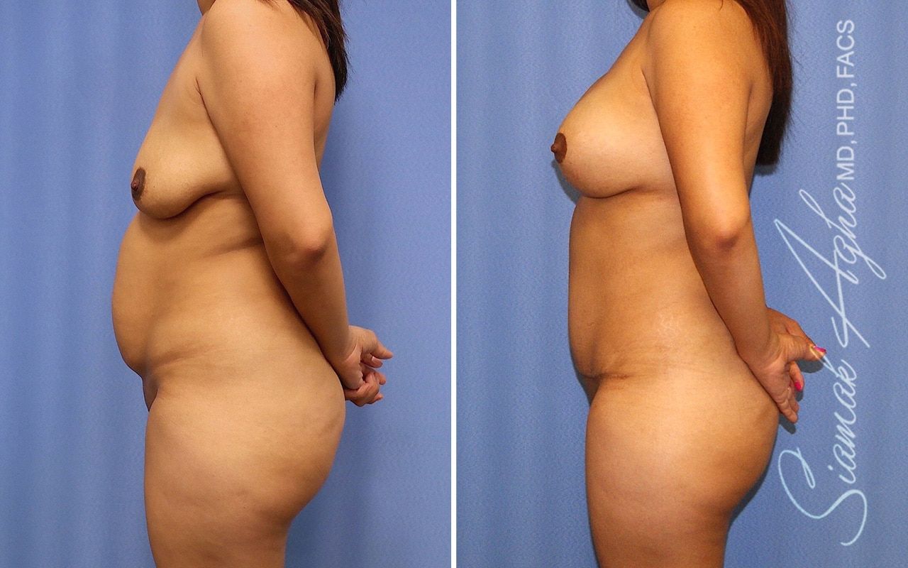 Mommy Makeover Before & After