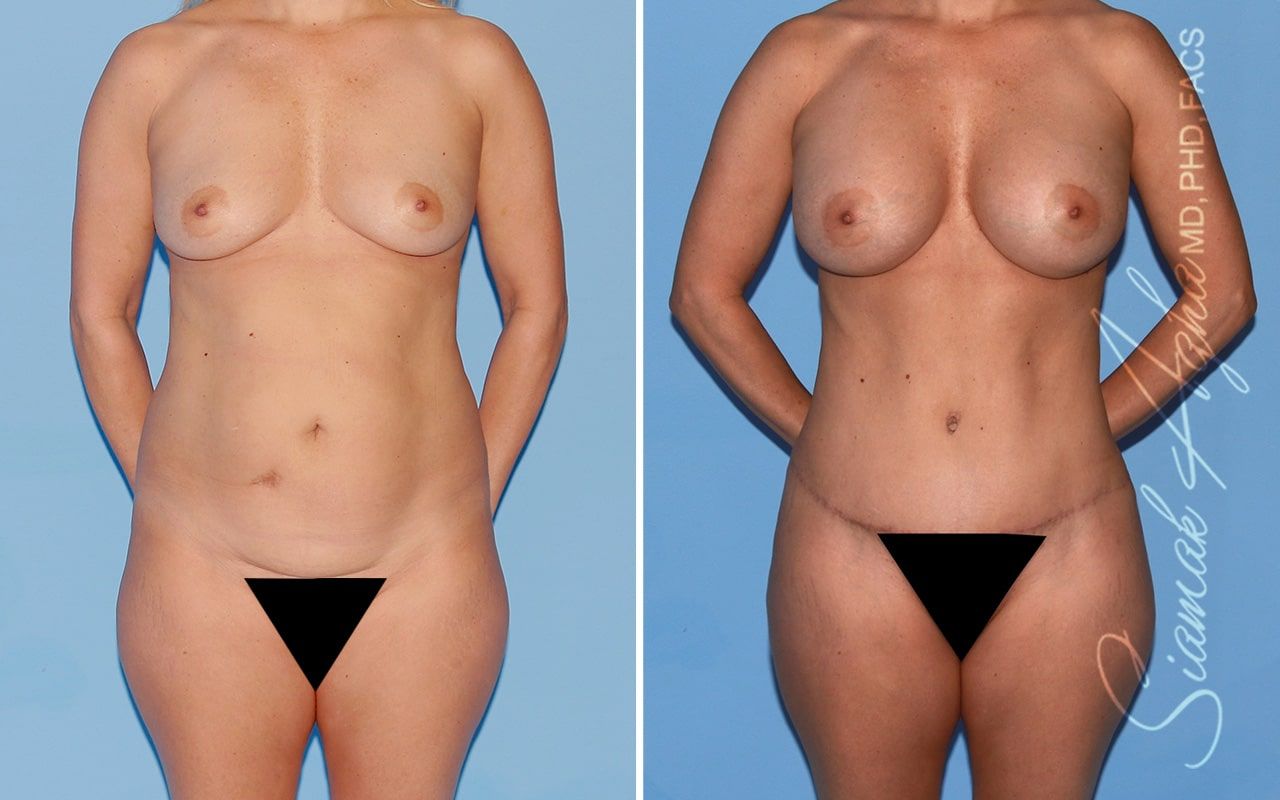 Mommy Makeover Before & After