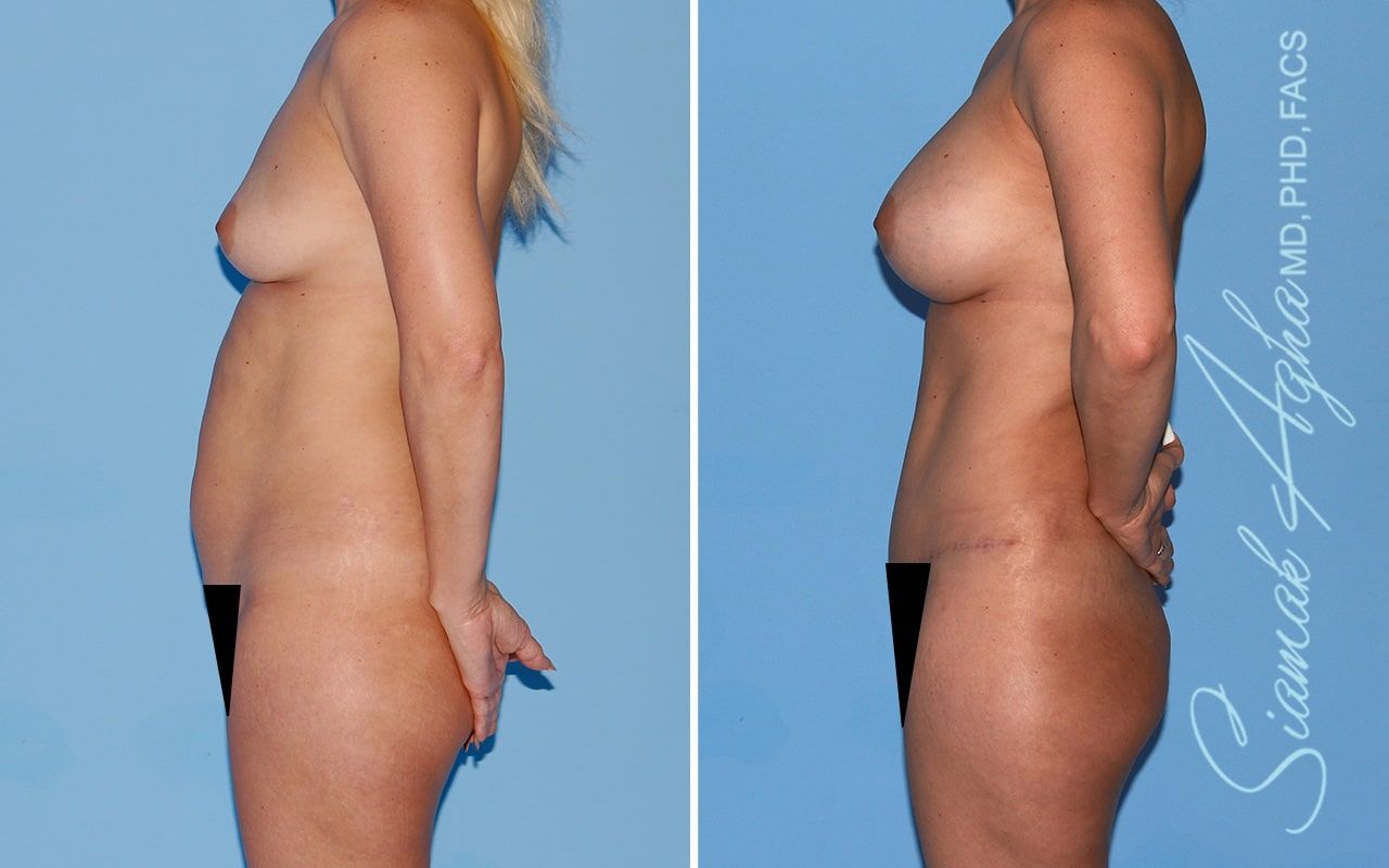 Mommy Makeover Before & After