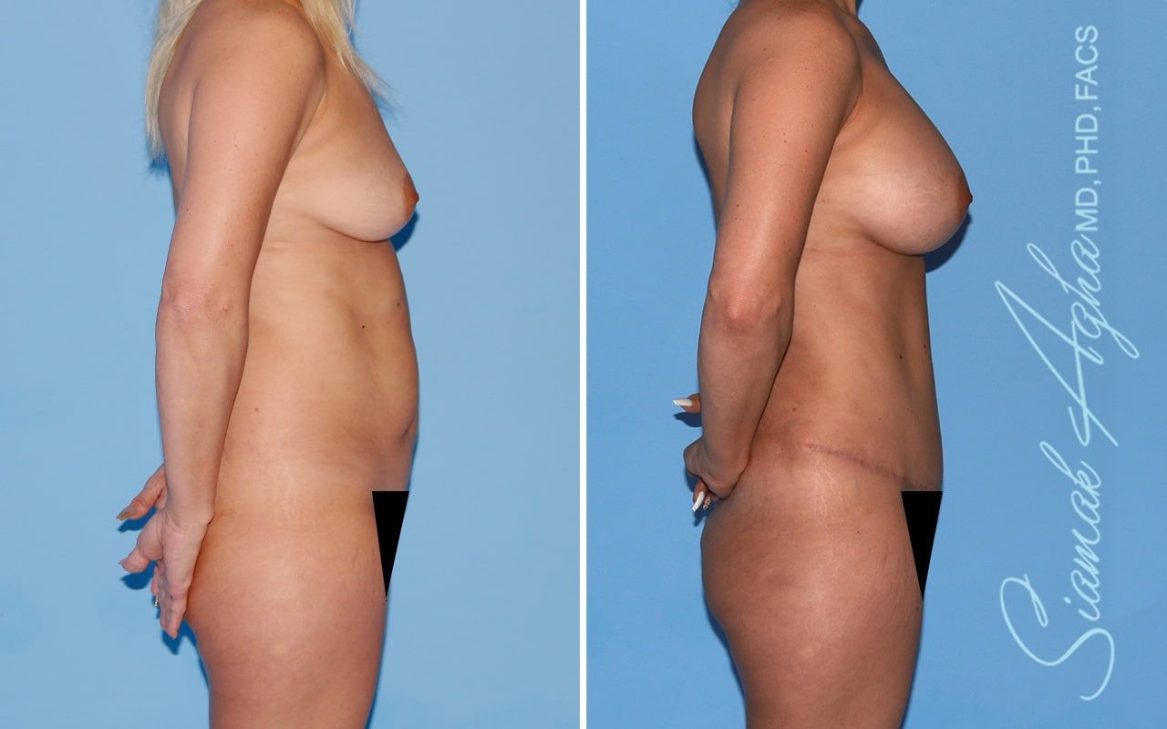 Mommy Makeover Before & After