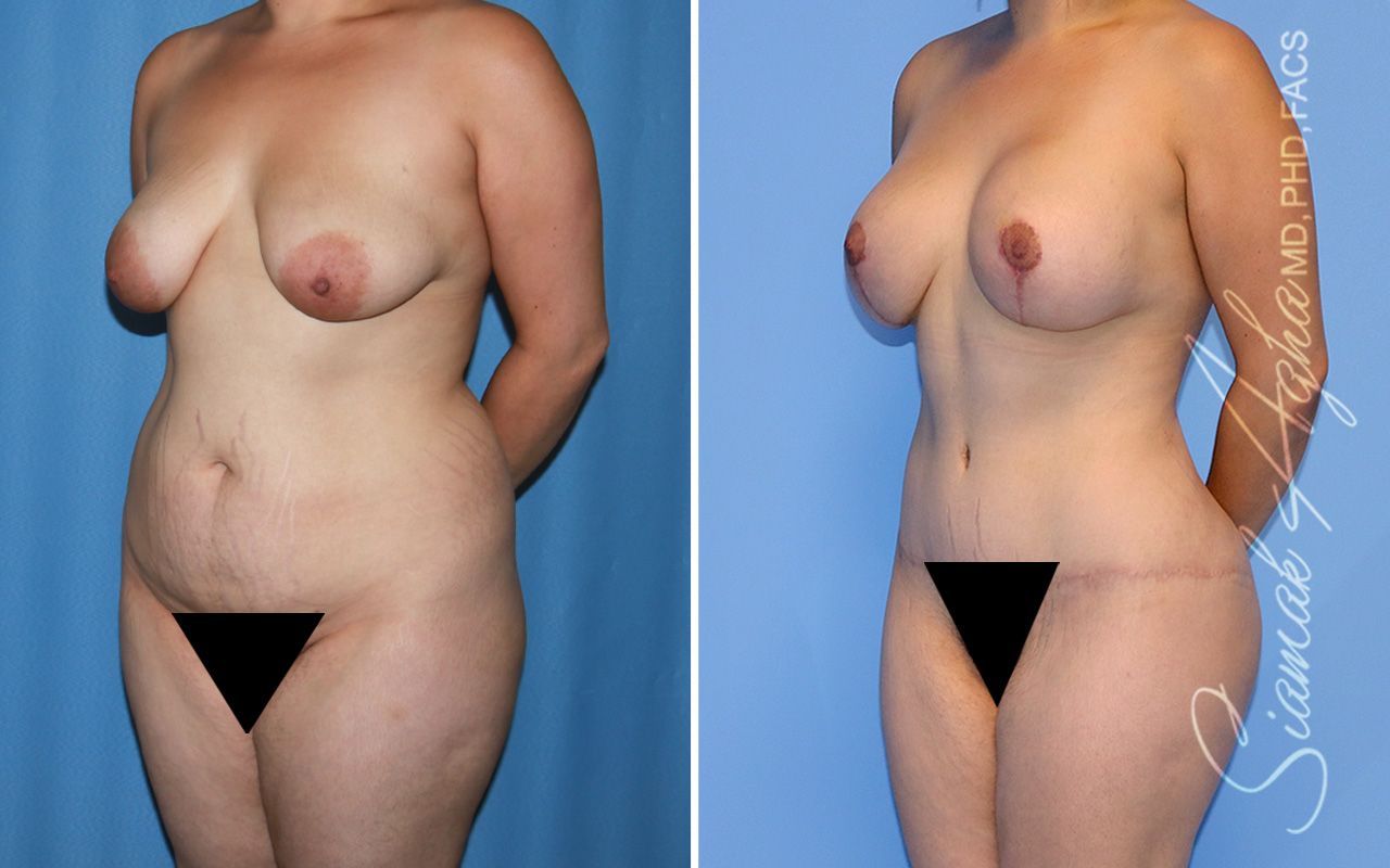 Mommy Makeover Before & After