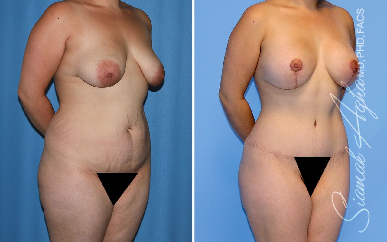 Mommy Makeover Before & After