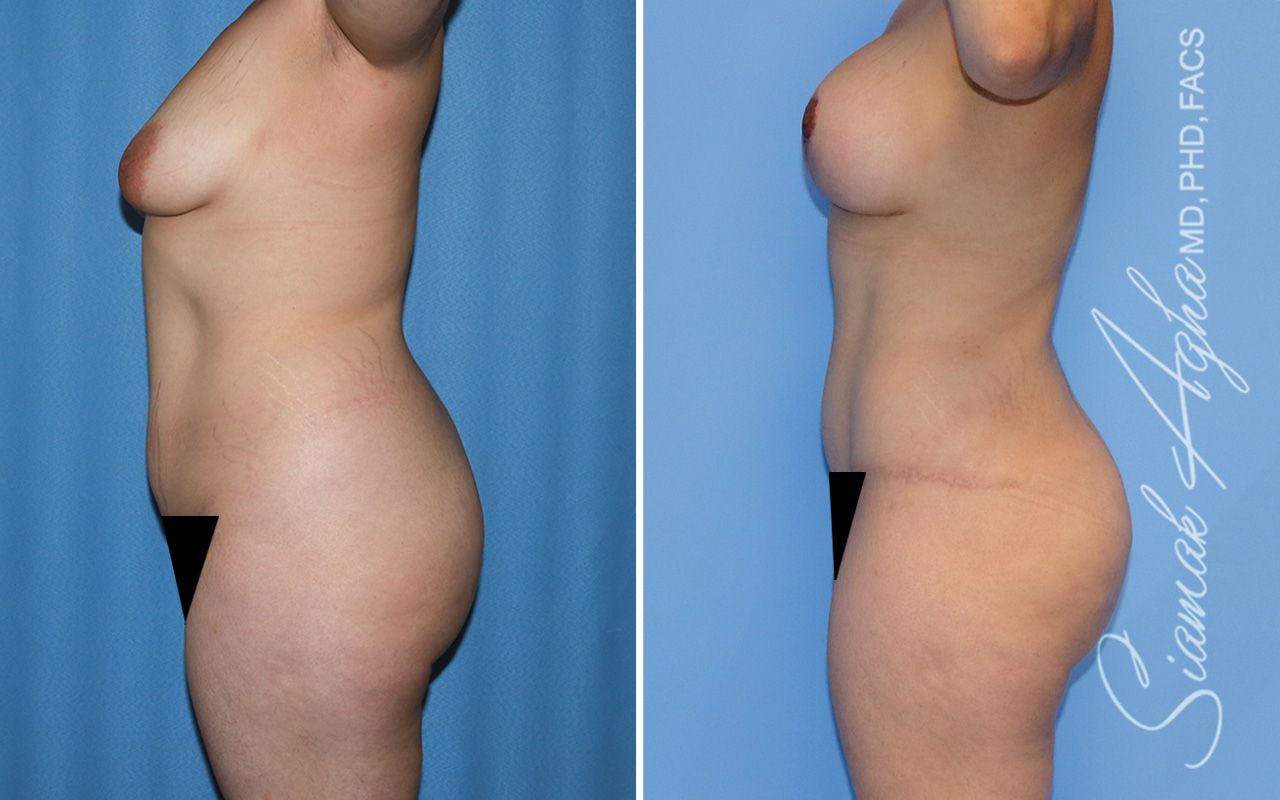 Mommy Makeover Before & After