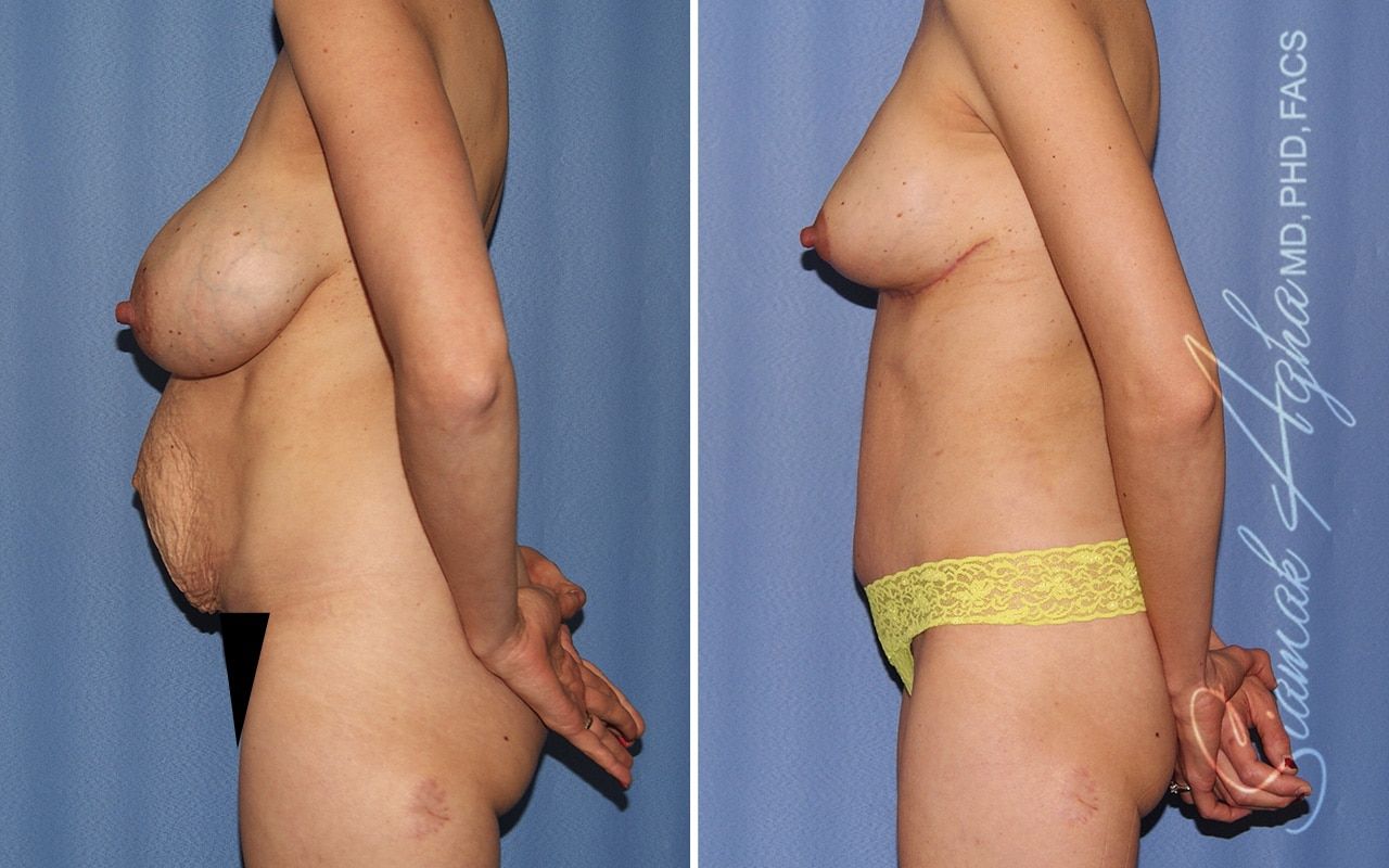 Mommy Makeover Before & After