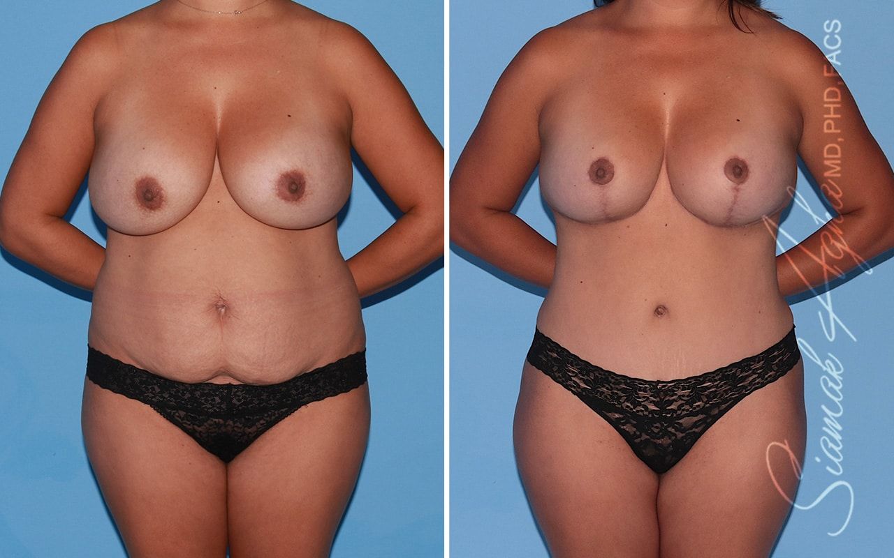 Mommy Makeover Before & After