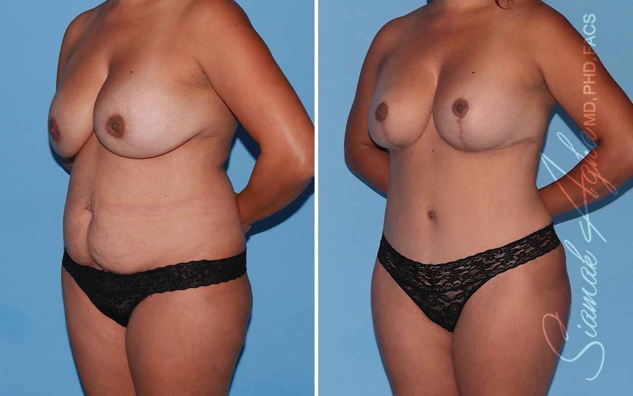 Mommy Makeover Before & After