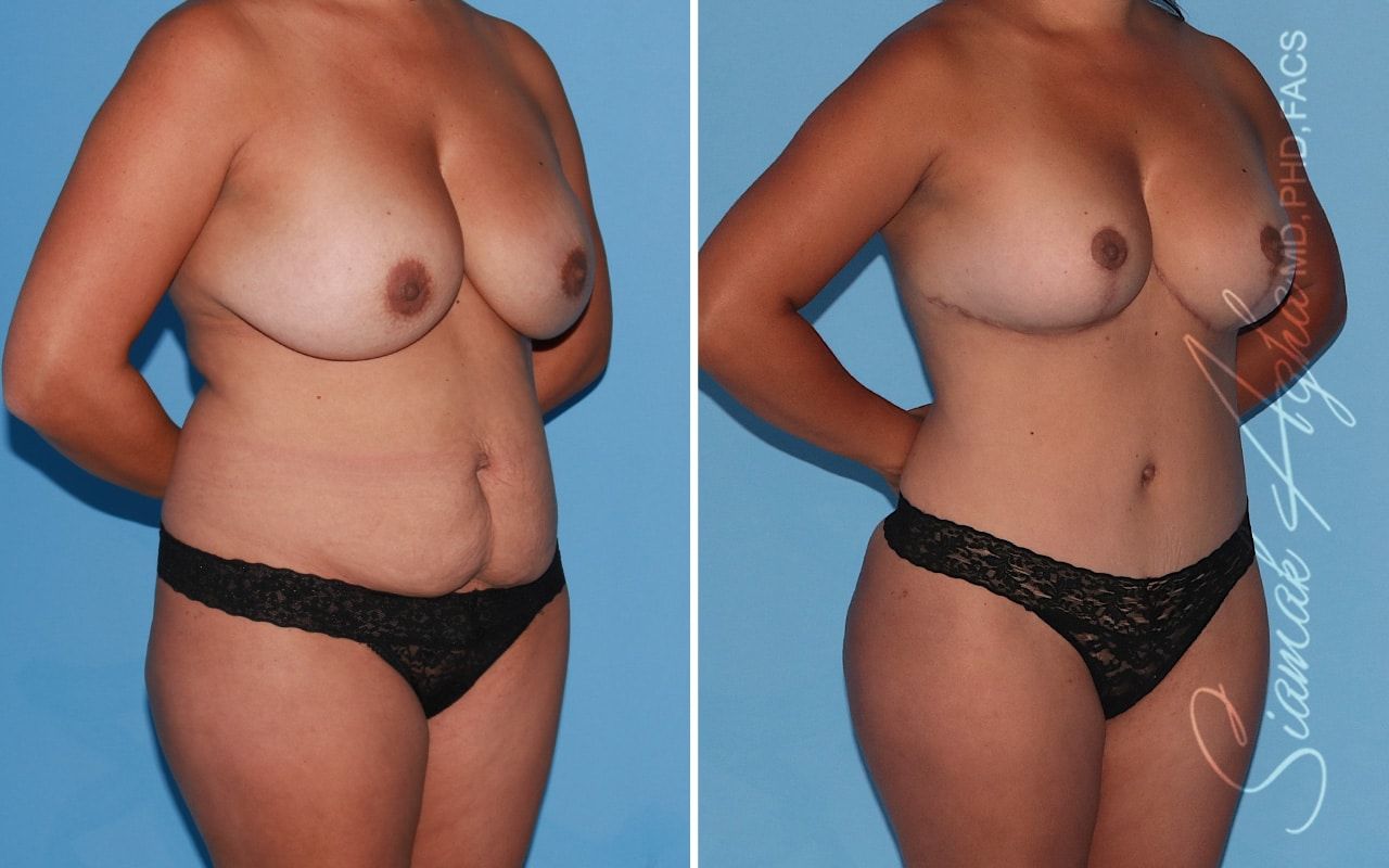 Mommy Makeover Before & After