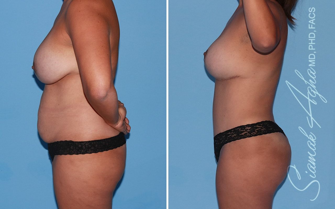 Mommy Makeover Before & After