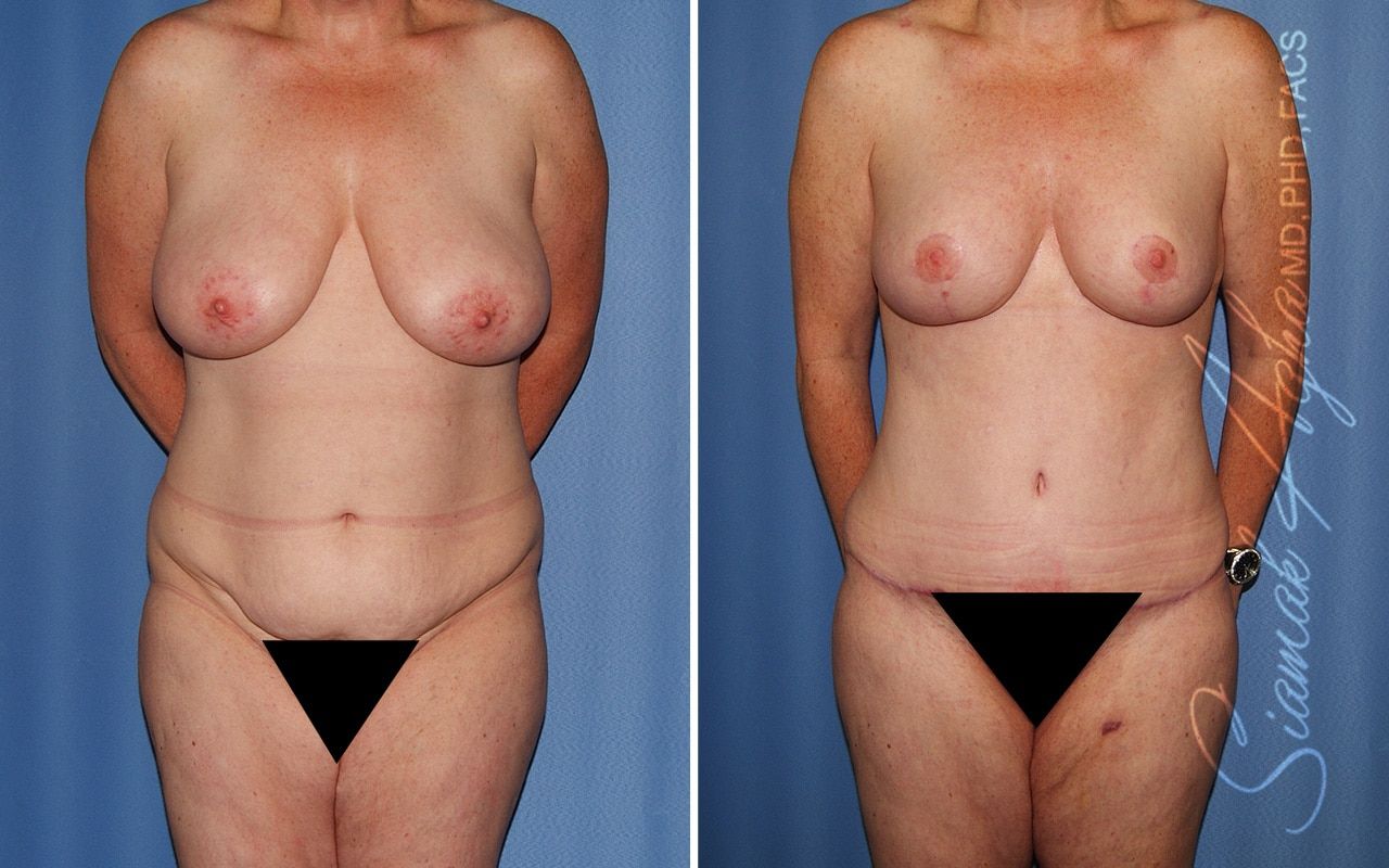 Mommy Makeover Before & After