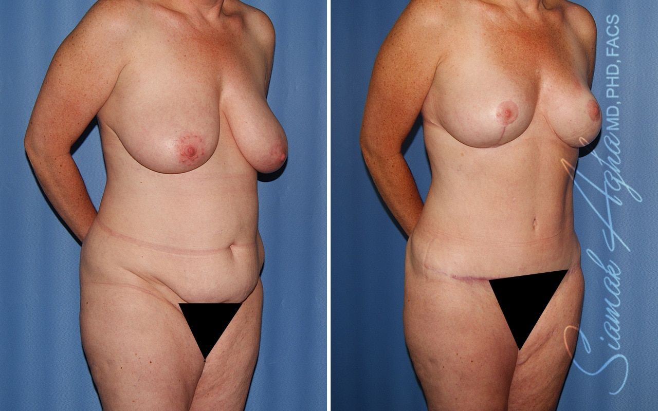 Mommy Makeover Before & After