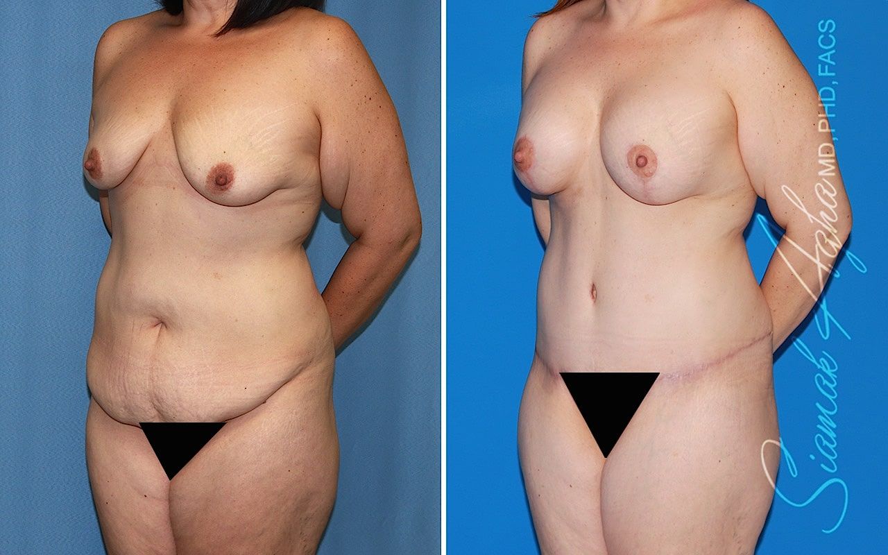 Mommy Makeover Before & After