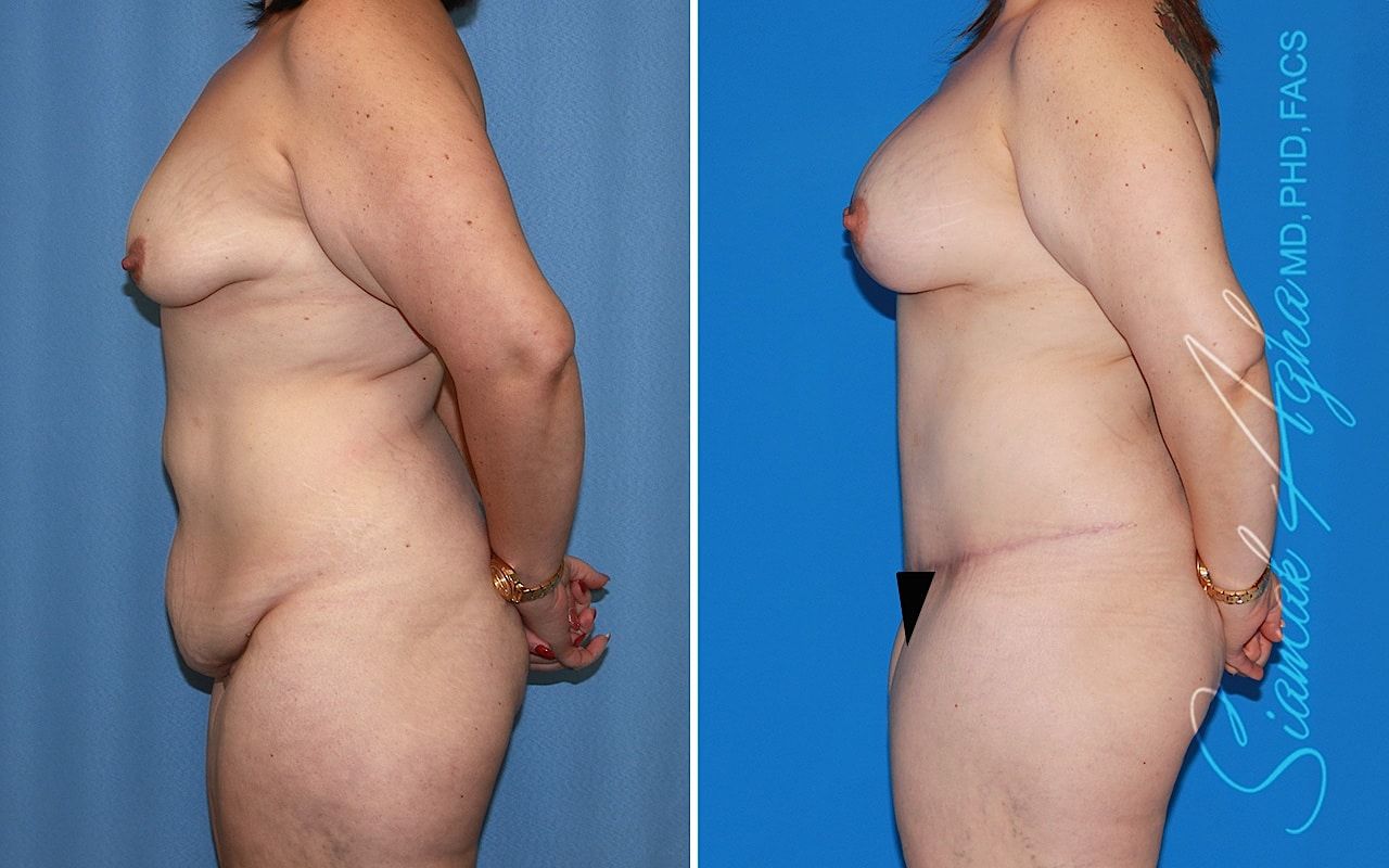 Mommy Makeover Before & After