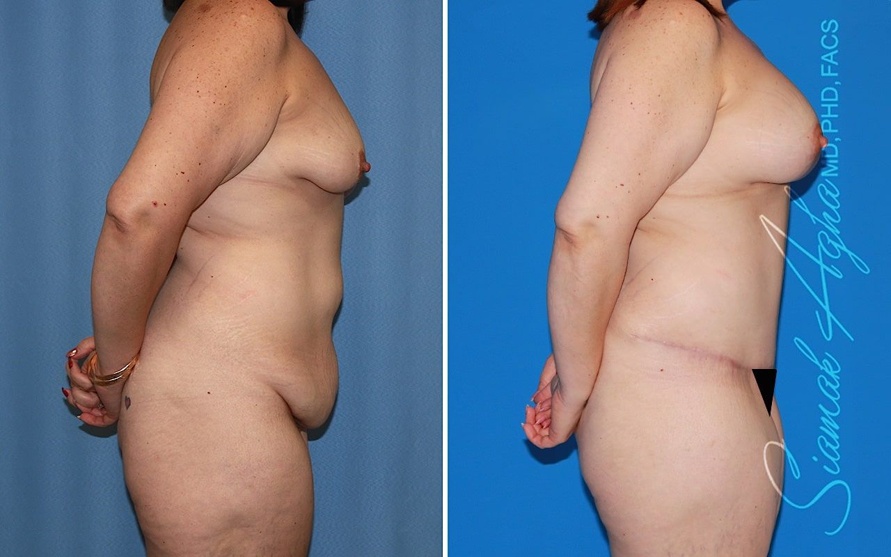 Mommy Makeover Before & After