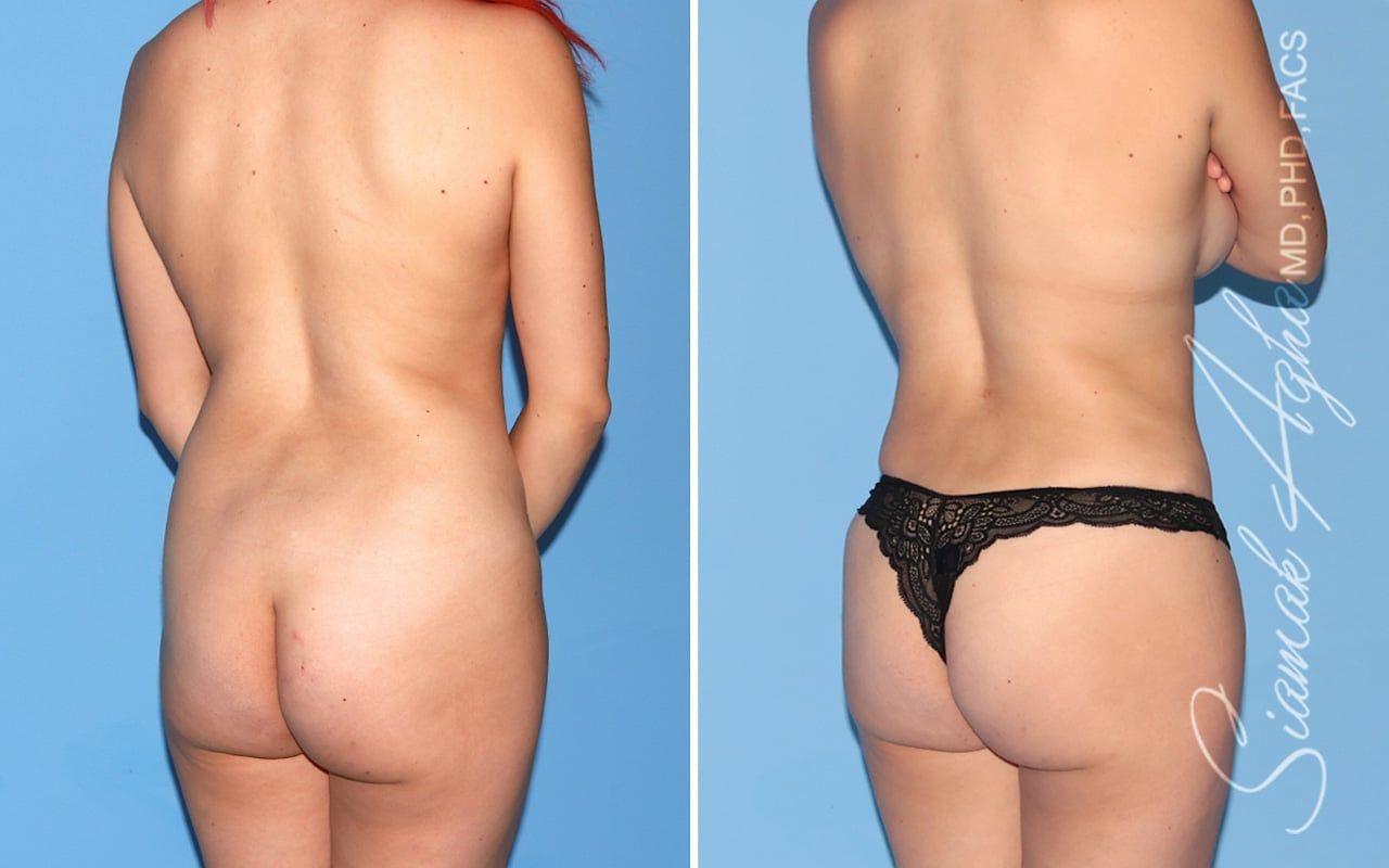 Mommy Makeover Before & After