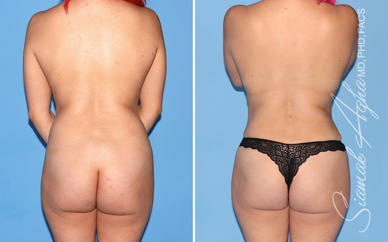 Mommy Makeover Before & After