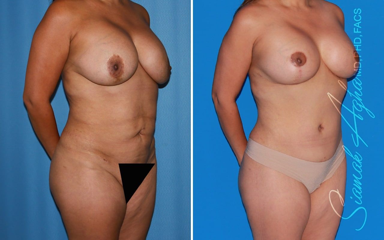 Mommy Makeover Before & After