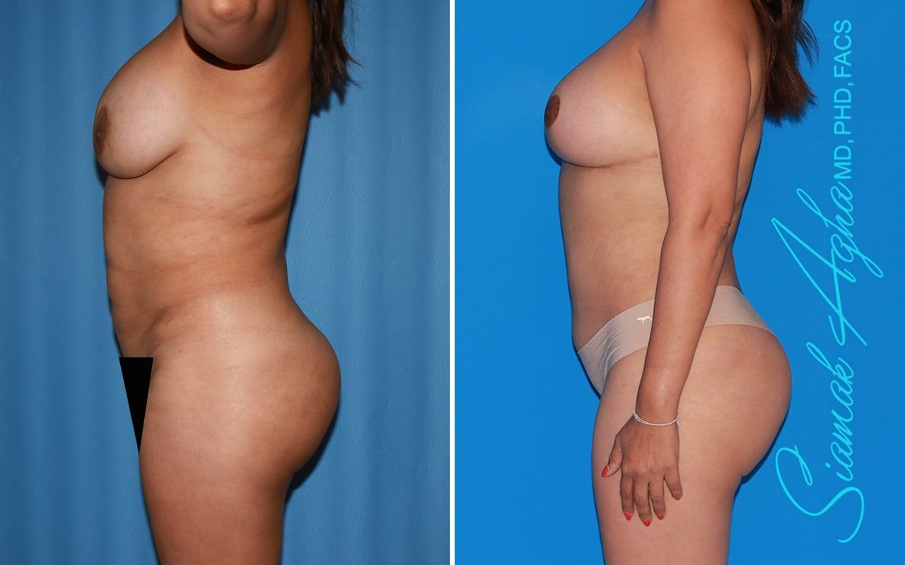 Mommy Makeover Before & After