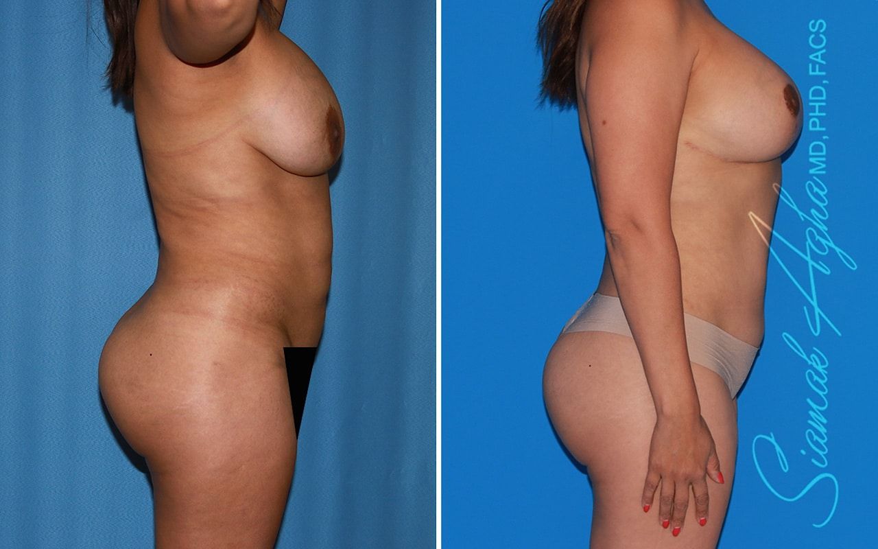 Mommy Makeover Before & After