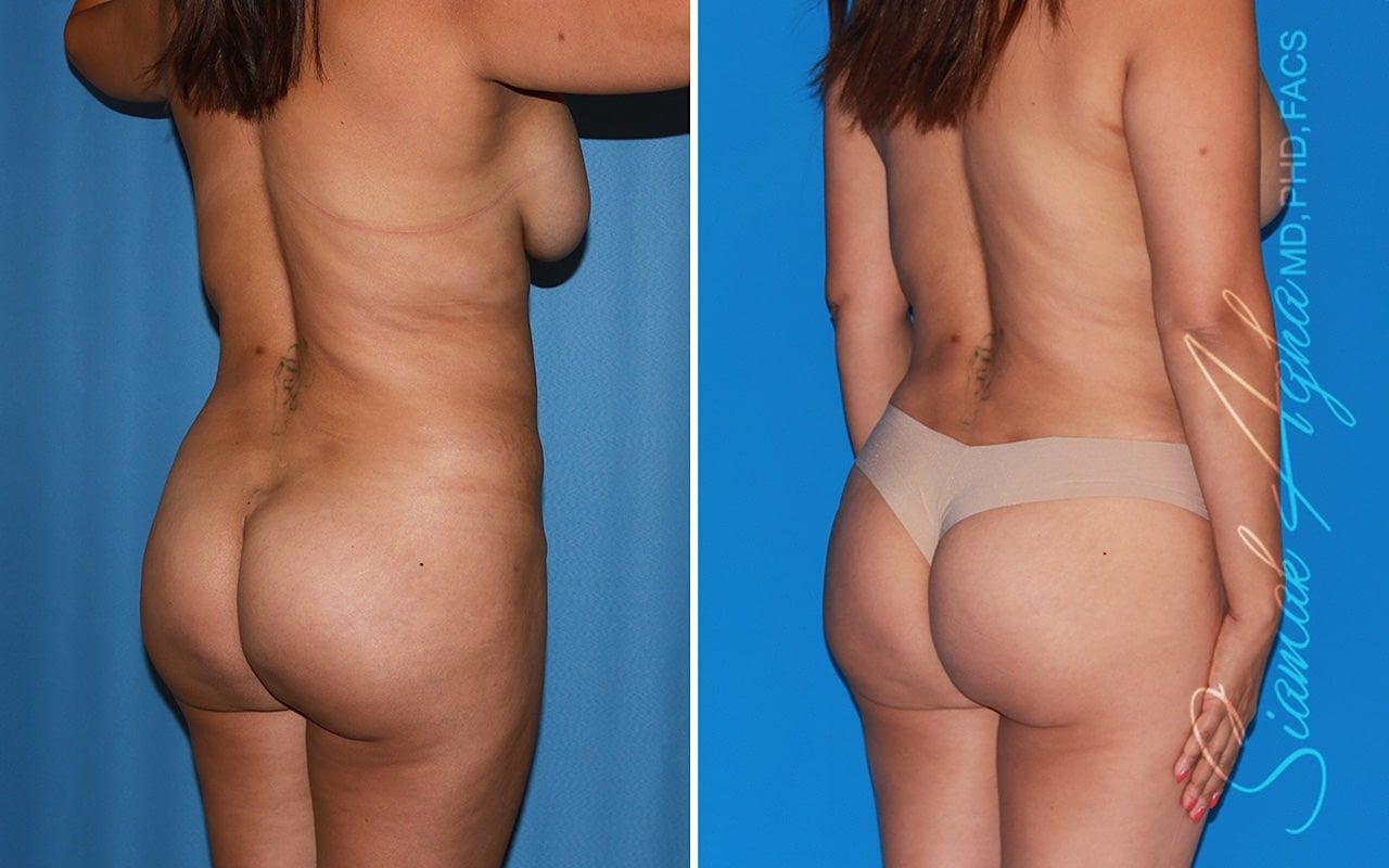 Mommy Makeover Before & After