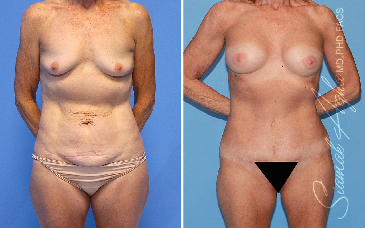 Mommy Makeover Before & After