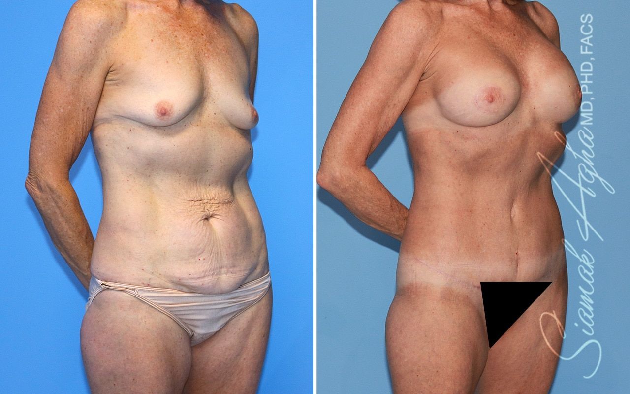 Mommy Makeover Before & After