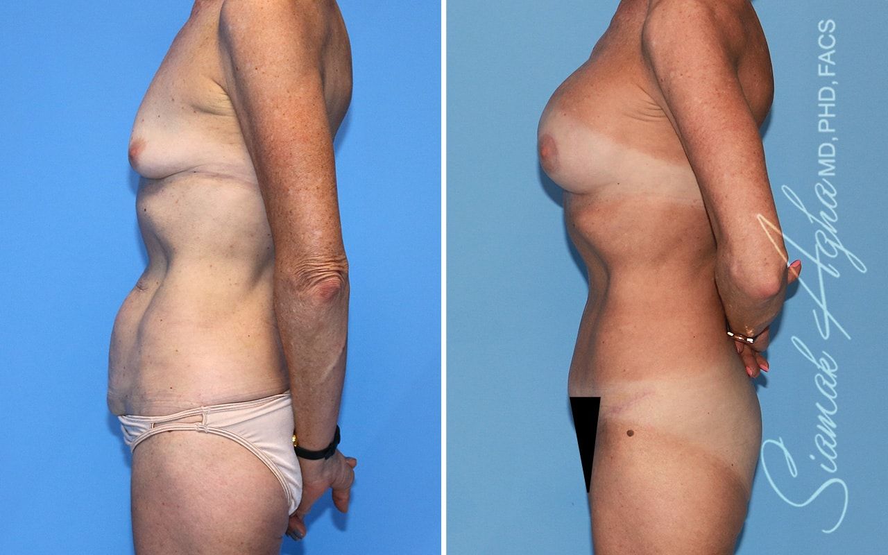 Mommy Makeover Before & After