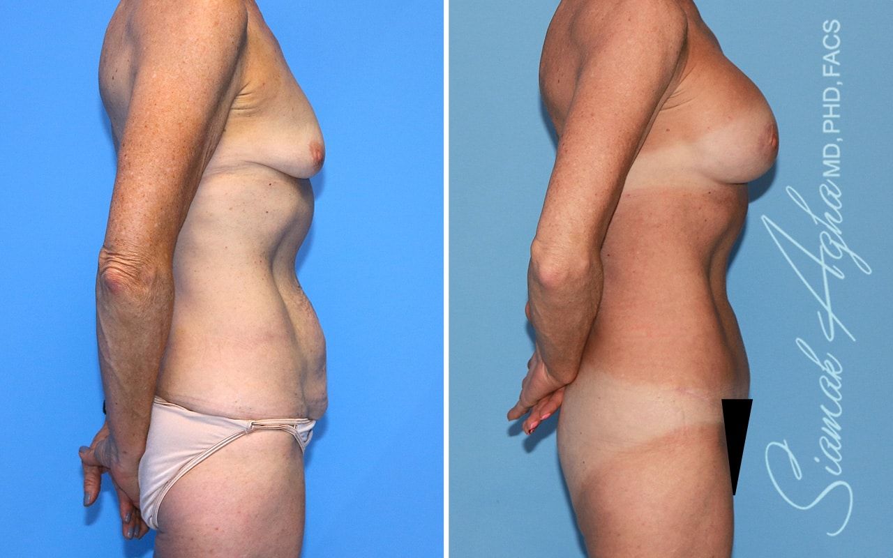 Mommy Makeover Before & After