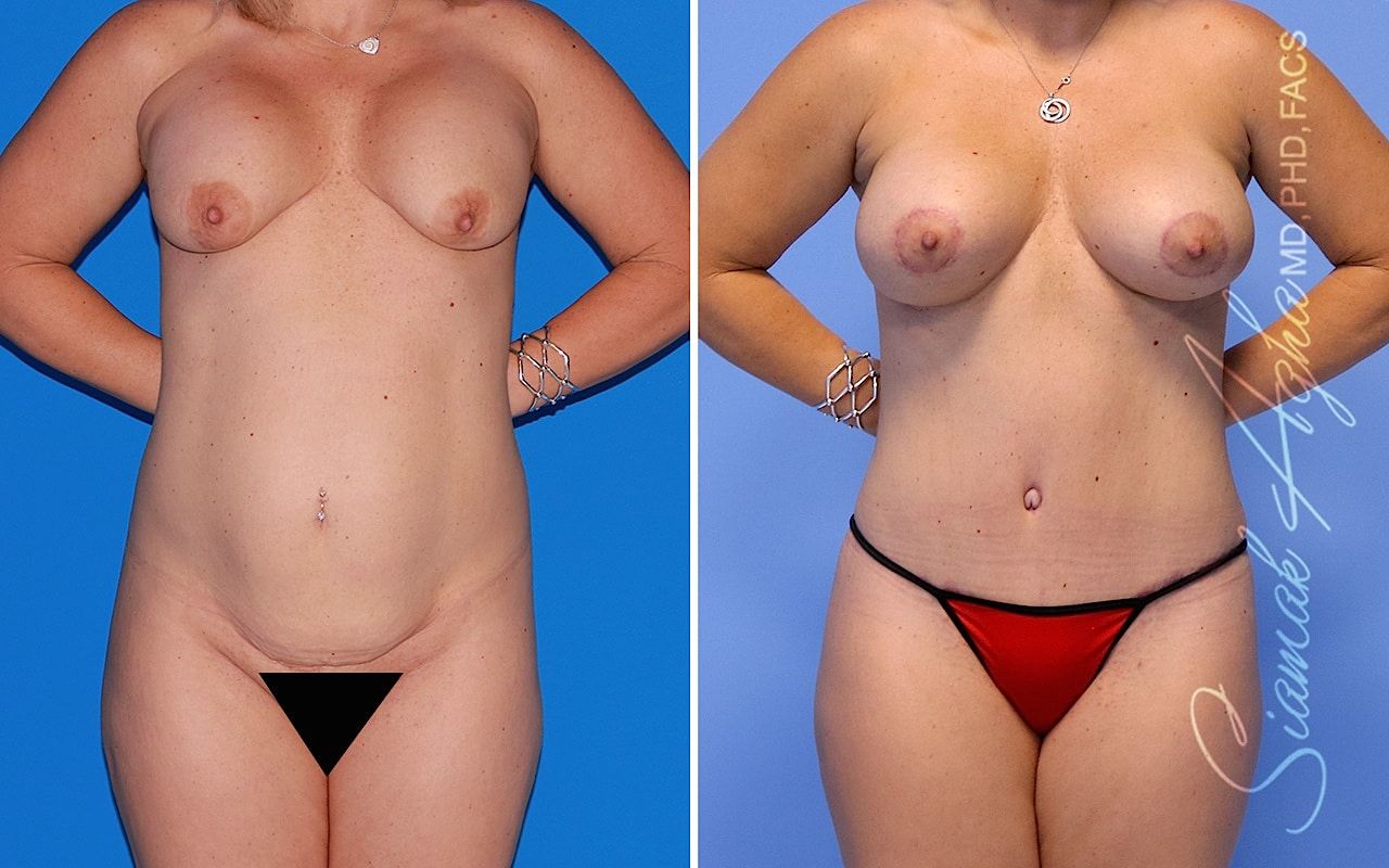 Mommy Makeover Before & After