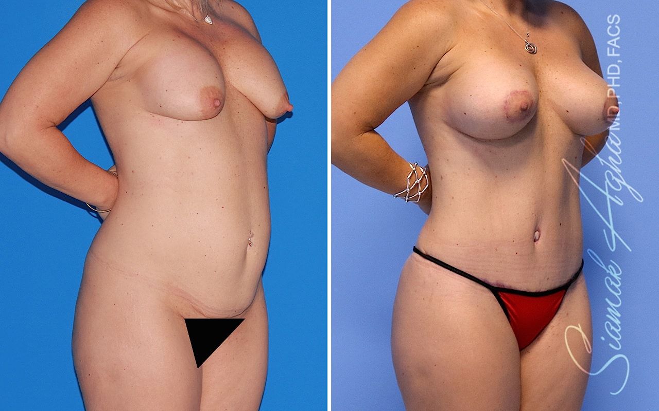 Mommy Makeover Before & After