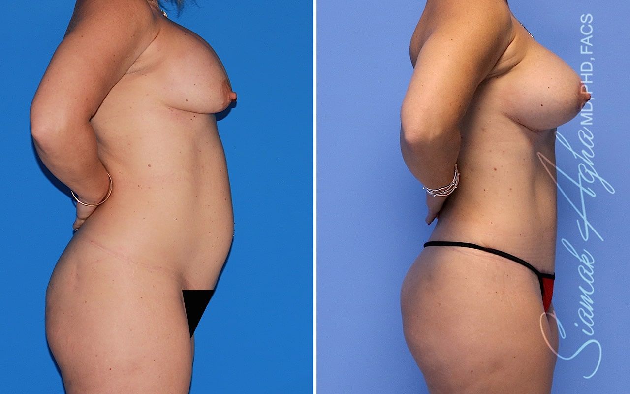 Mommy Makeover Before & After